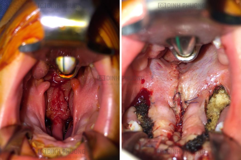 Phẫu thuật điều trị khe hở vòm - Dr Dinh Phuong