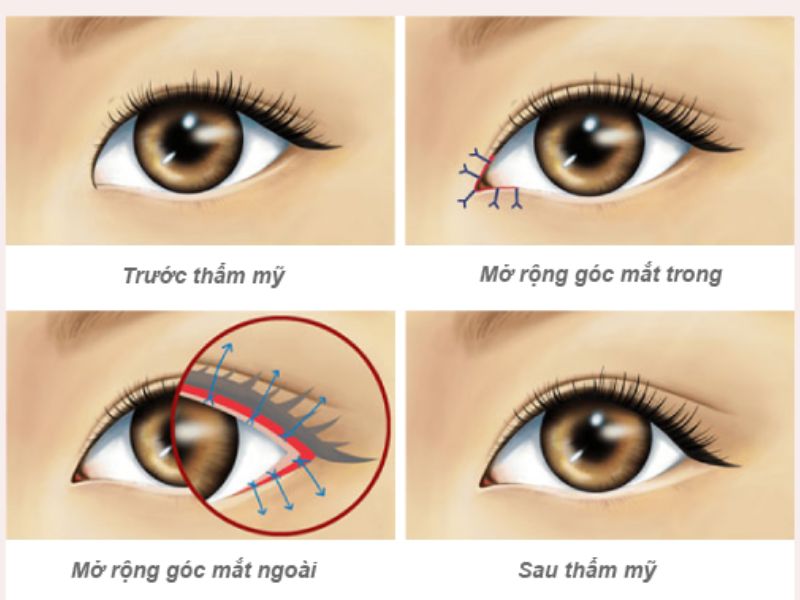 Mở rộng góc mắt là gì?