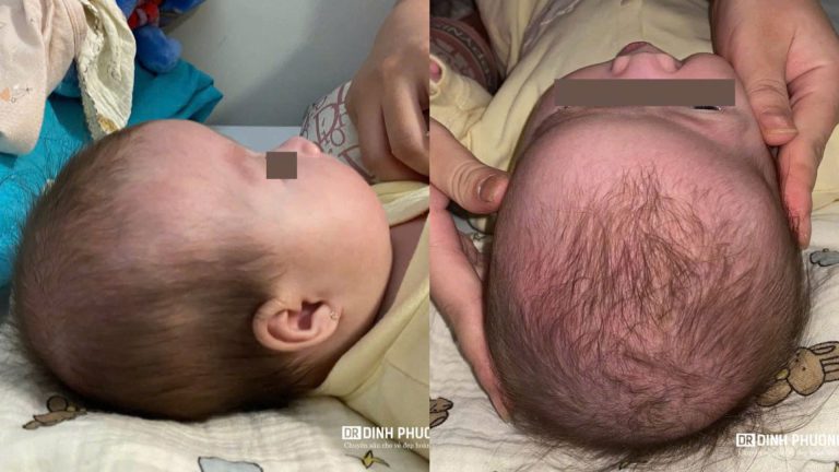 Hẹp sọ bẩm sinh