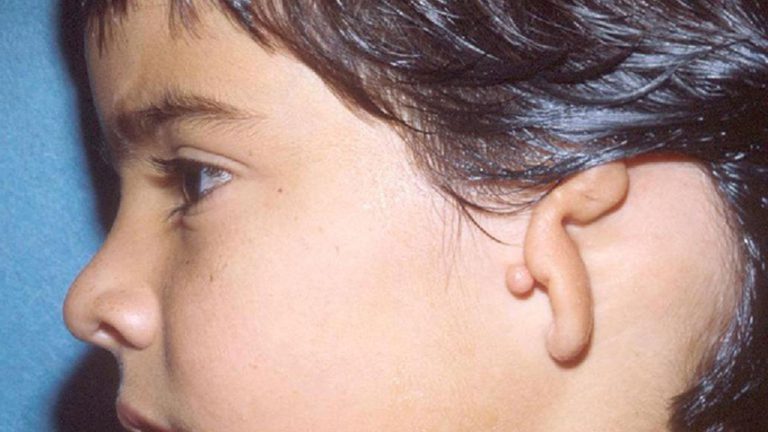 DỊ TẬT TAI Ở TRẺ SƠ SINH