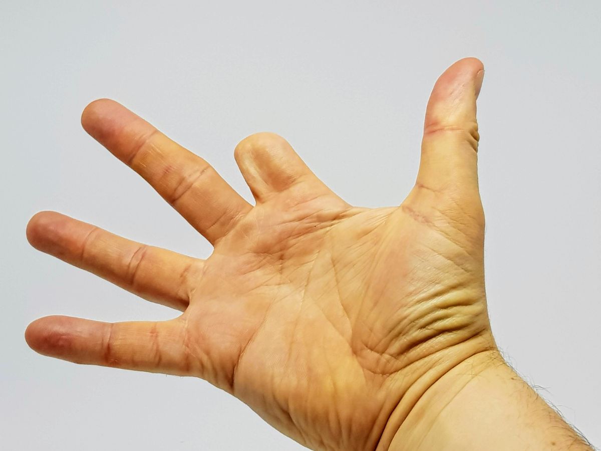 Hình ảnh dị tật thiếu ngón tay