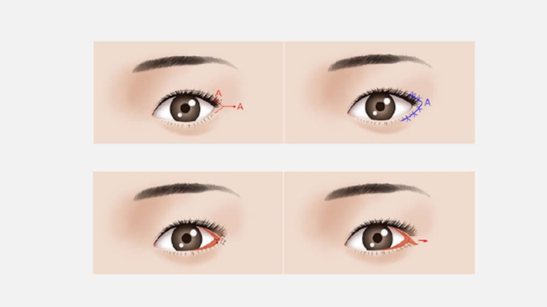 Hình ảnh mở rộng góc mắt