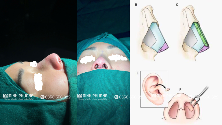 Hình ảnh phẫu thuật nâng mũi cấu trúc