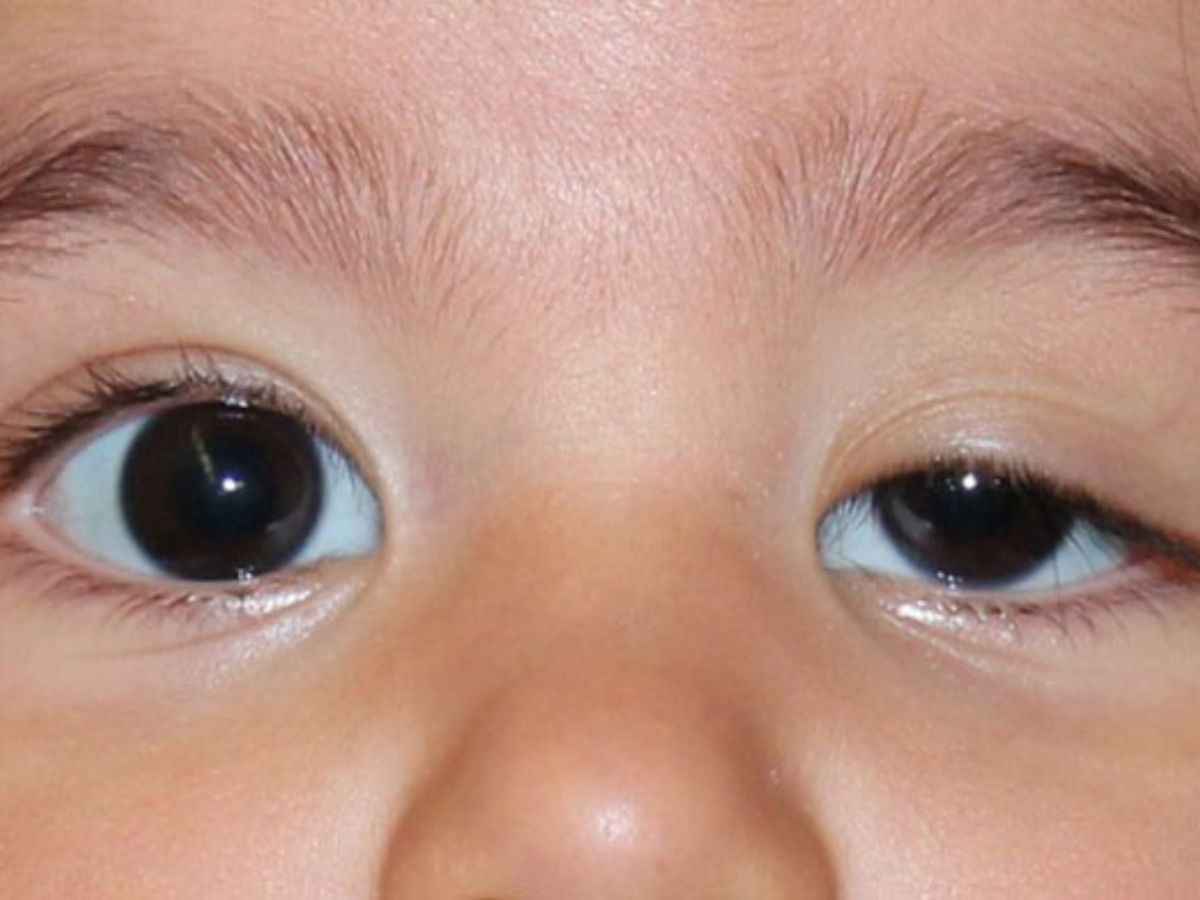 Hình ảnh sụp mí mắt ở trẻ