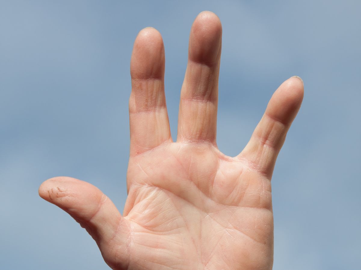 Dịt tật bàn tay thiếu ngón áp út khá phổ biến 