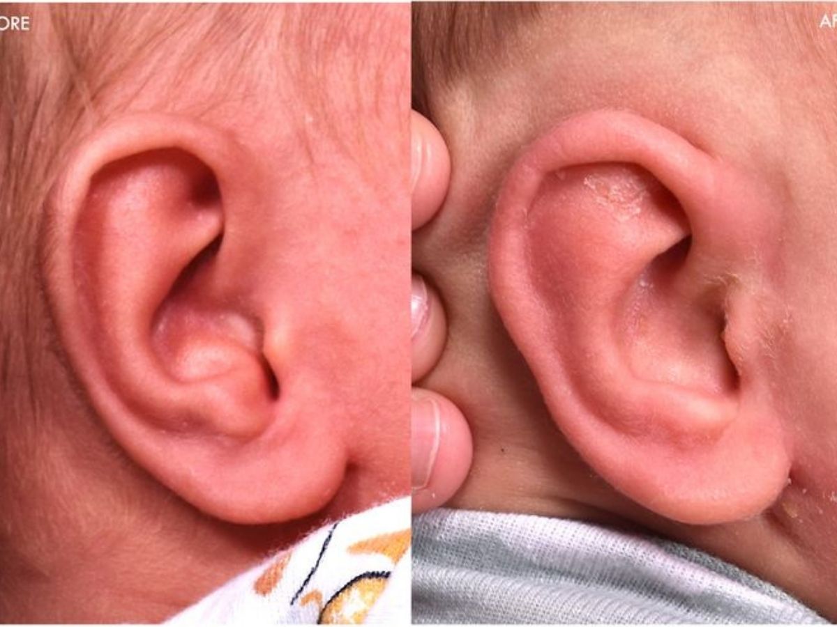 Biểu hiện dị tật tai nhỏ ở trẻ.