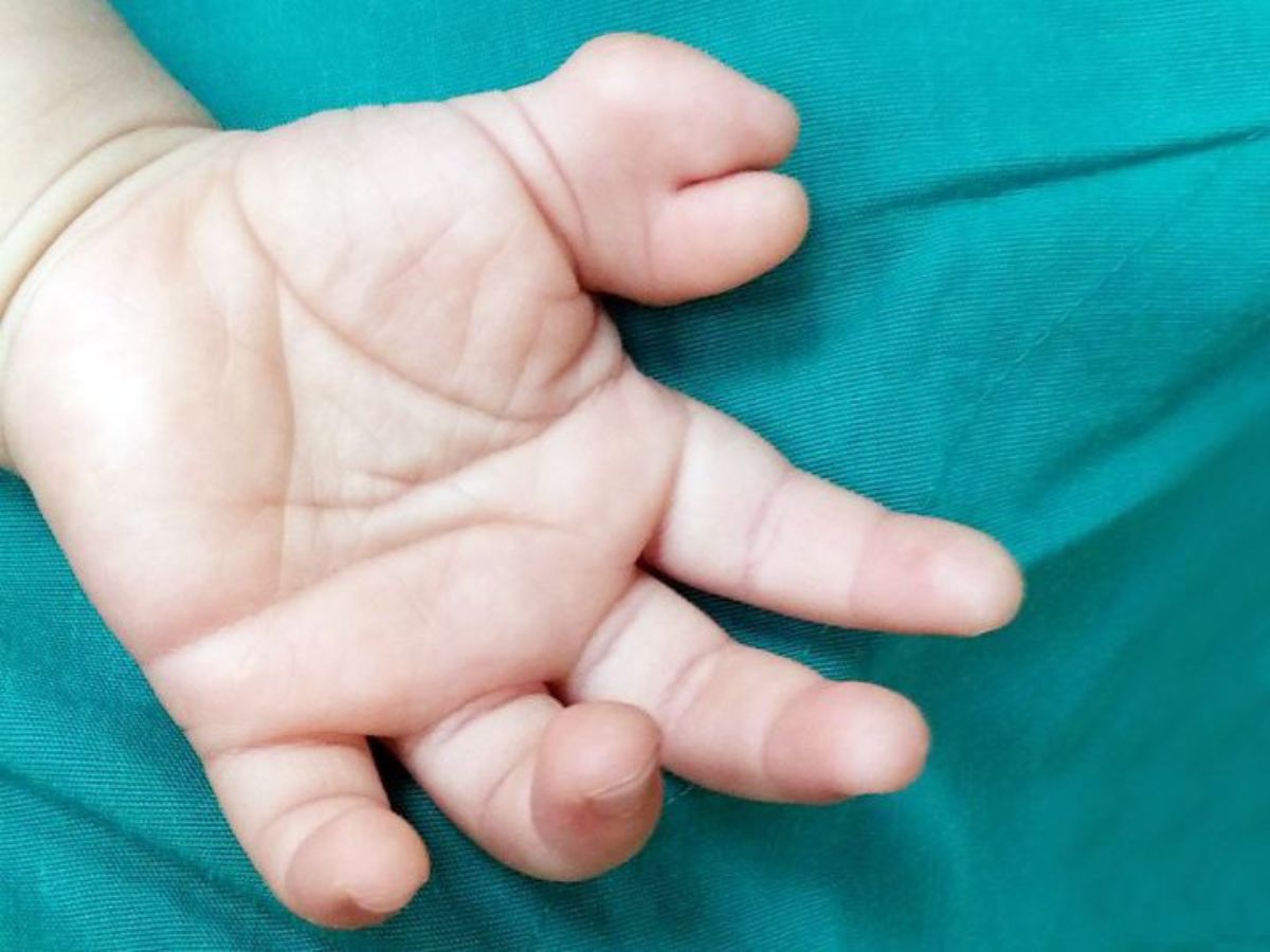 Hình ảnh dị tật thừa ngón tay cái