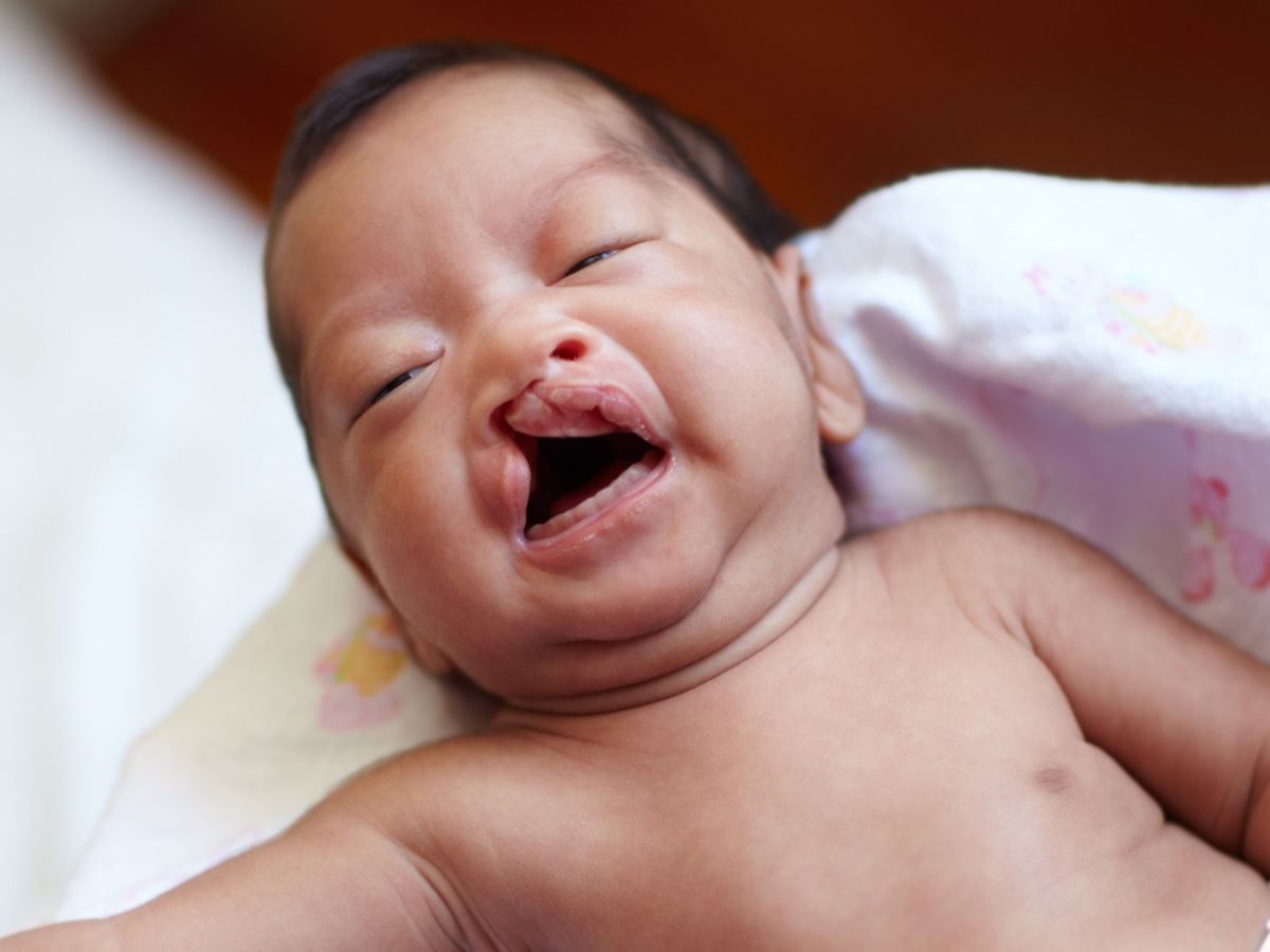 Khe hở môi bẩm sinh
