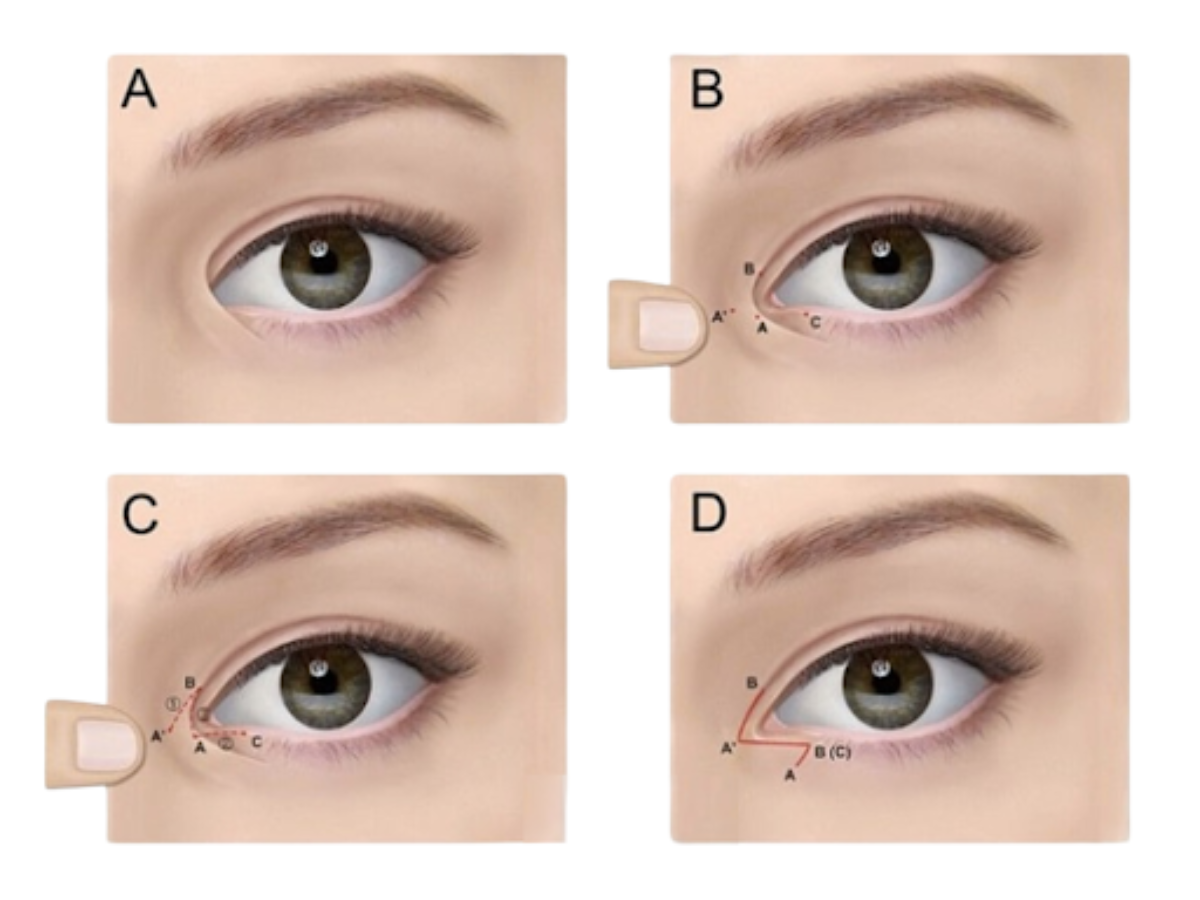 Hình ảnh minh họa mở góc mắt trong
