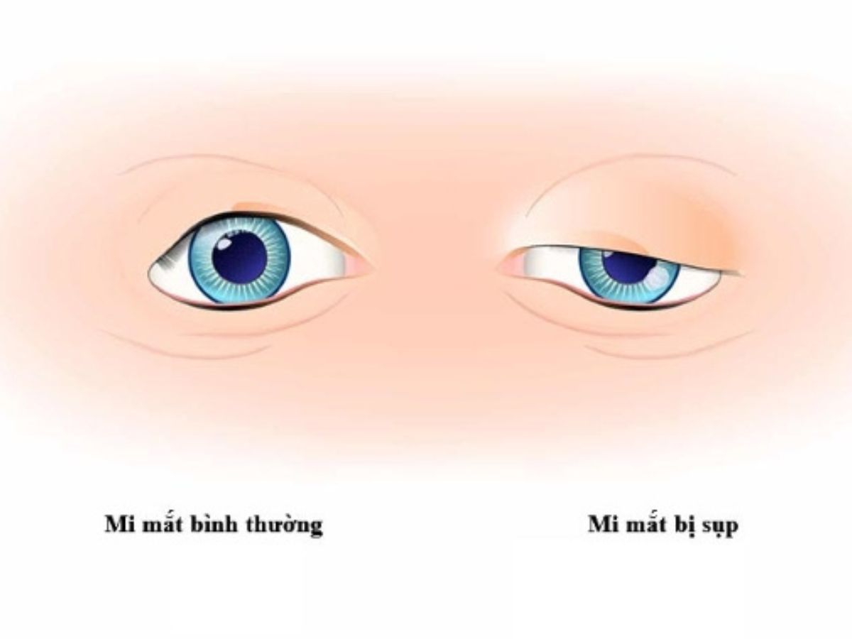 Cách xác định tình trạng sụp mí mắt 