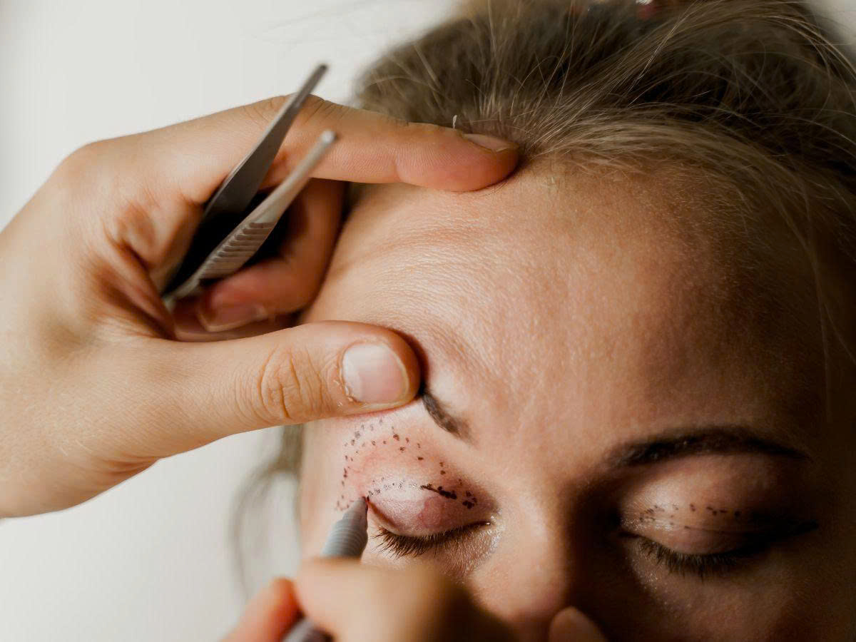 Tìm hiểu tổng quan về phương pháp phẫu thuật mí đôi