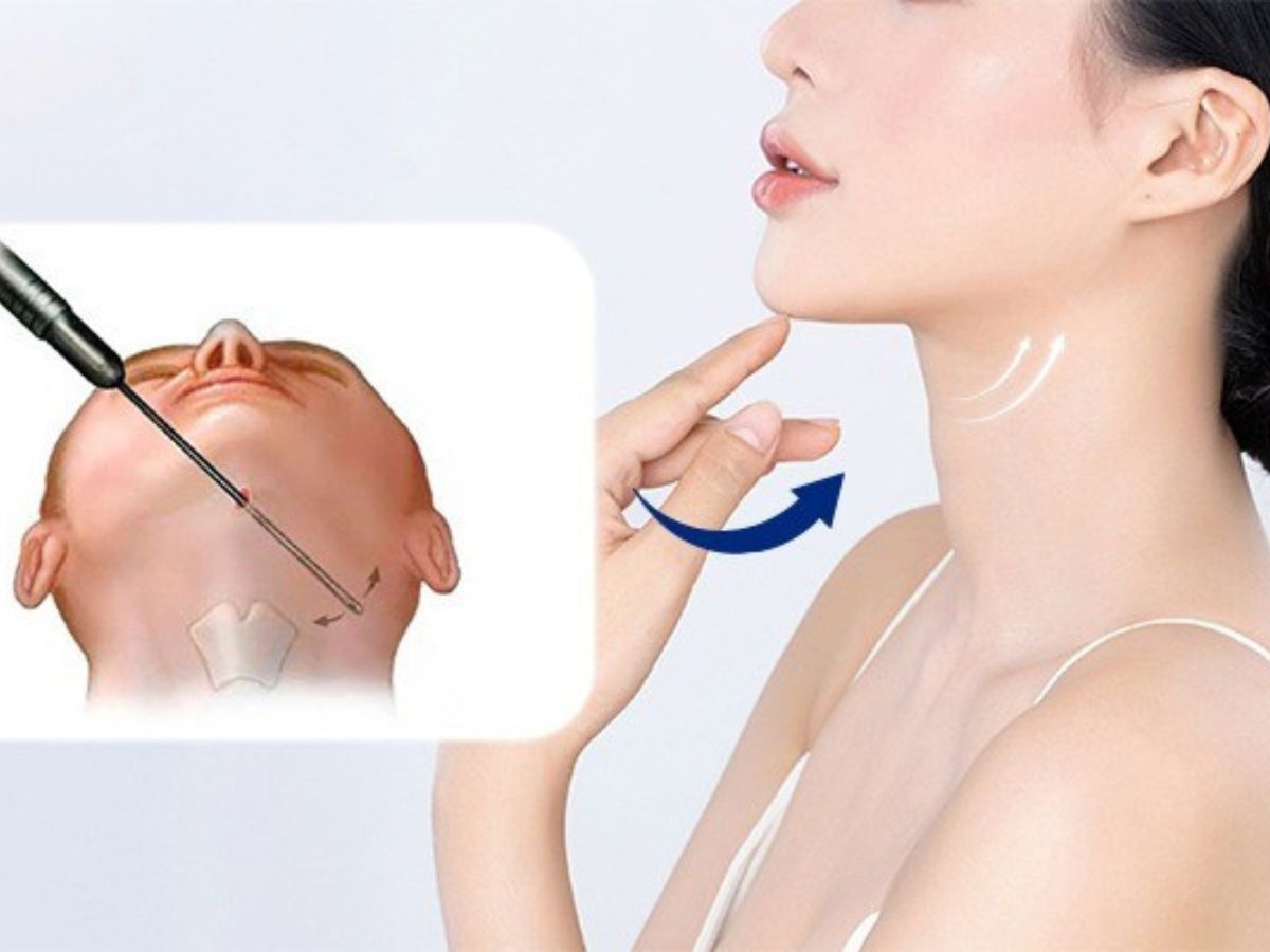 Tìm hiểu về phương pháp hút mỡ nọng cằm