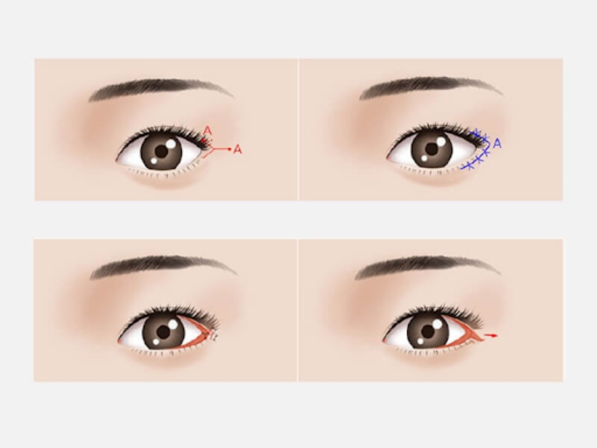 Hình ảnh minh họa dạng hình vẽ mở rộng góc mắt ngoài