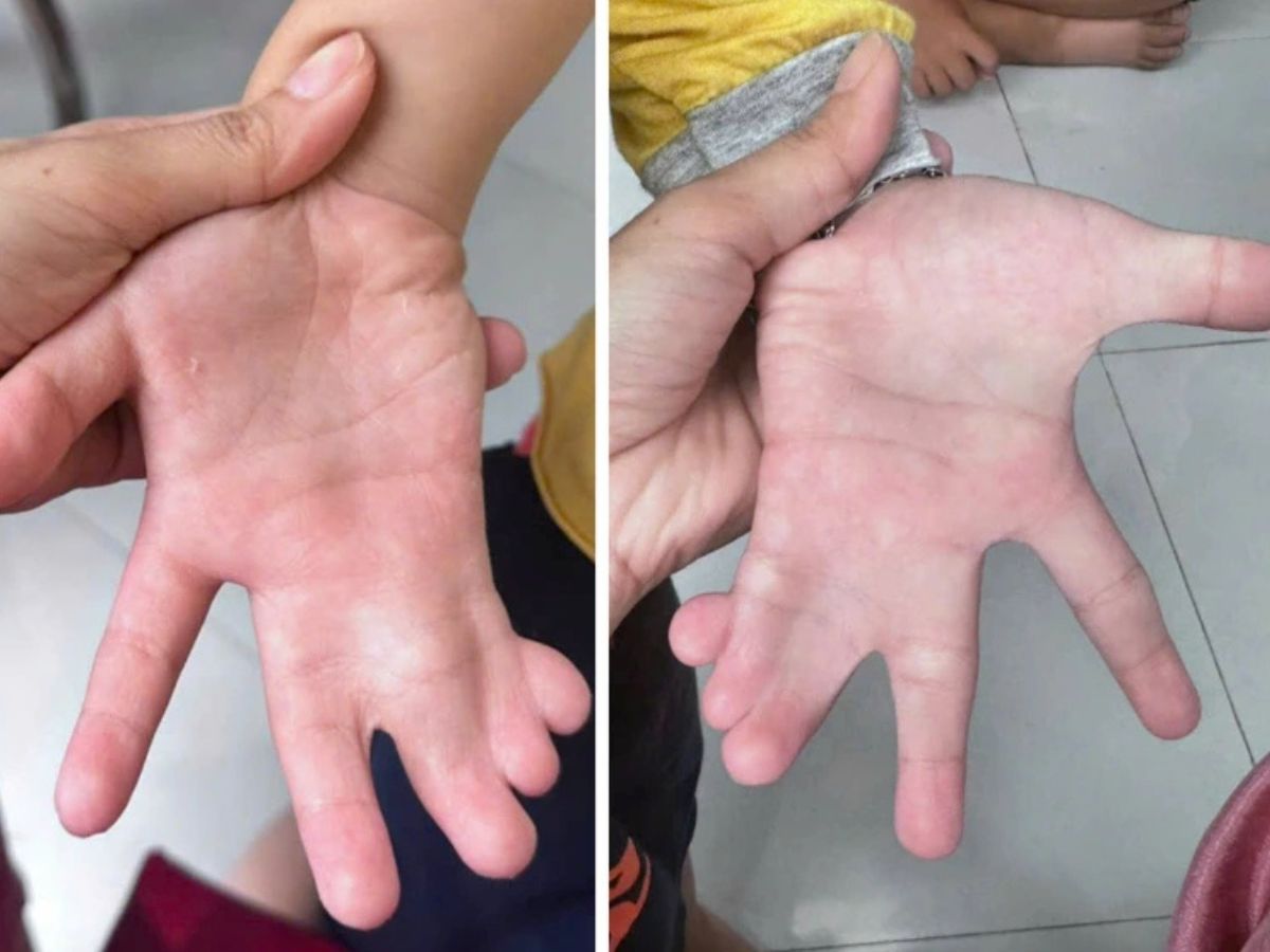 Hình ảnh dị tật dính ngón tay
