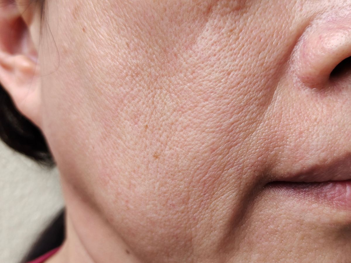 Đối tượng phù hợp với phẫu thuật căng da mặt