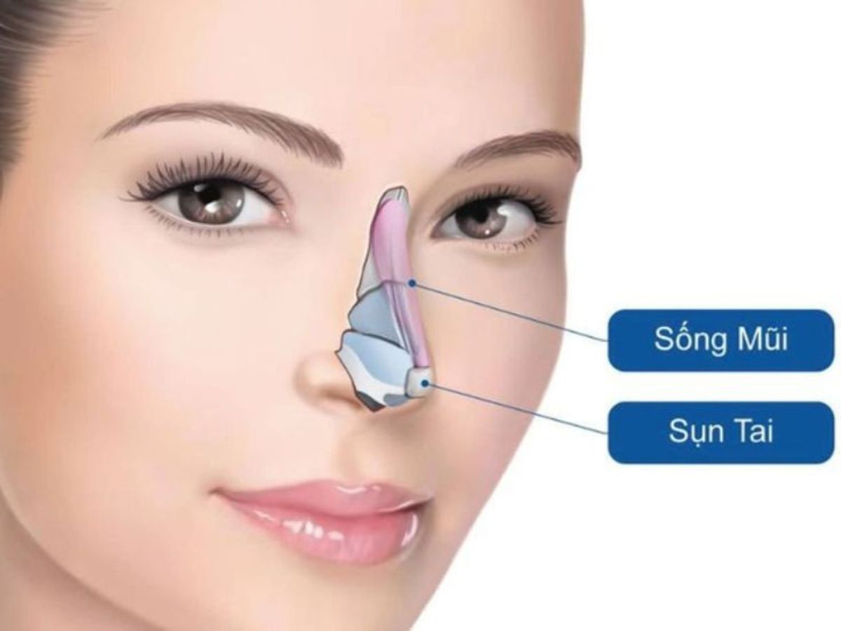 Ưu, nhược điểm khi thực hiện phẫu thuật nâng mũi cấu trúc