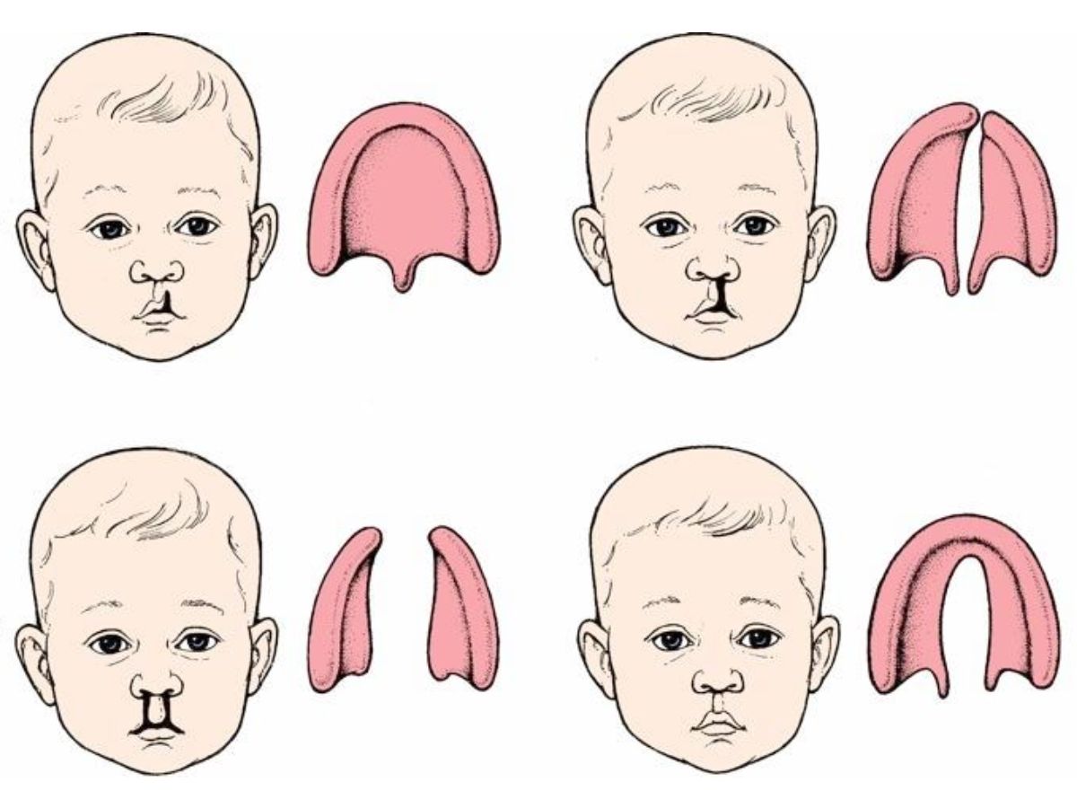 Một số dạng khe hở môi thường gặp ở trẻ sơ sinh