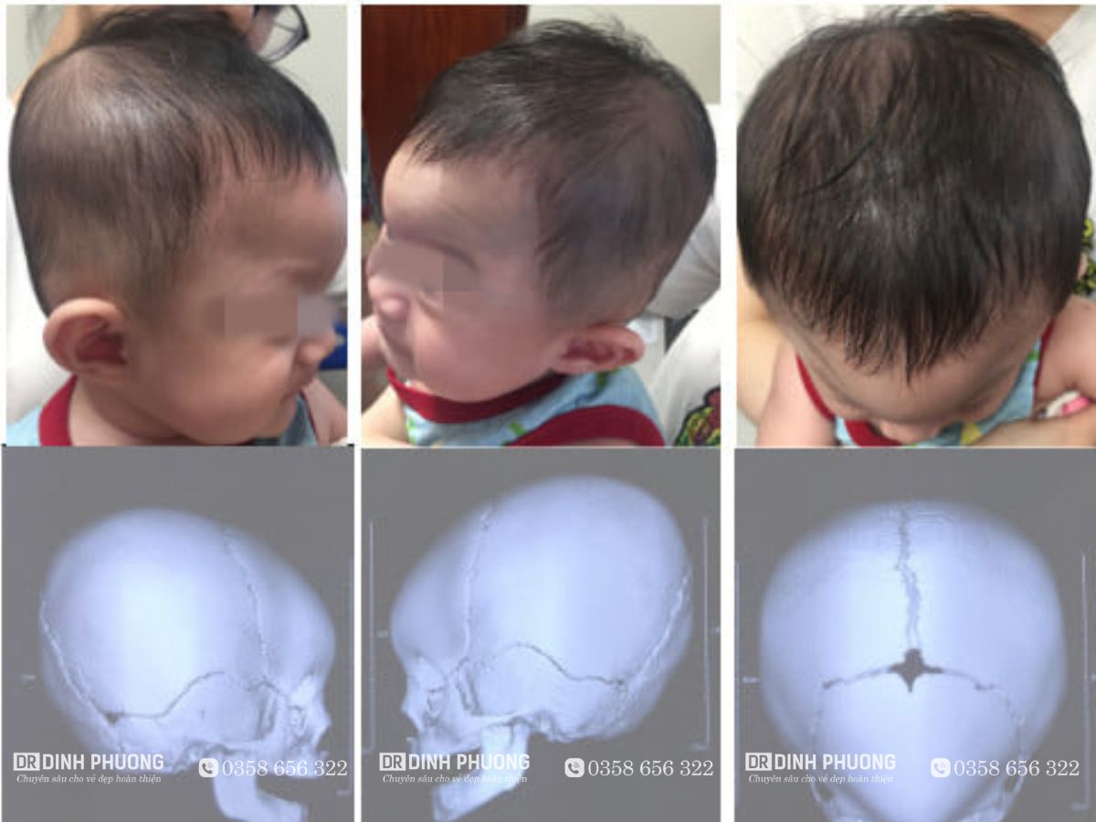 Một số hình ảnh bé bị hẹp sọ bẩm sinh từ bé