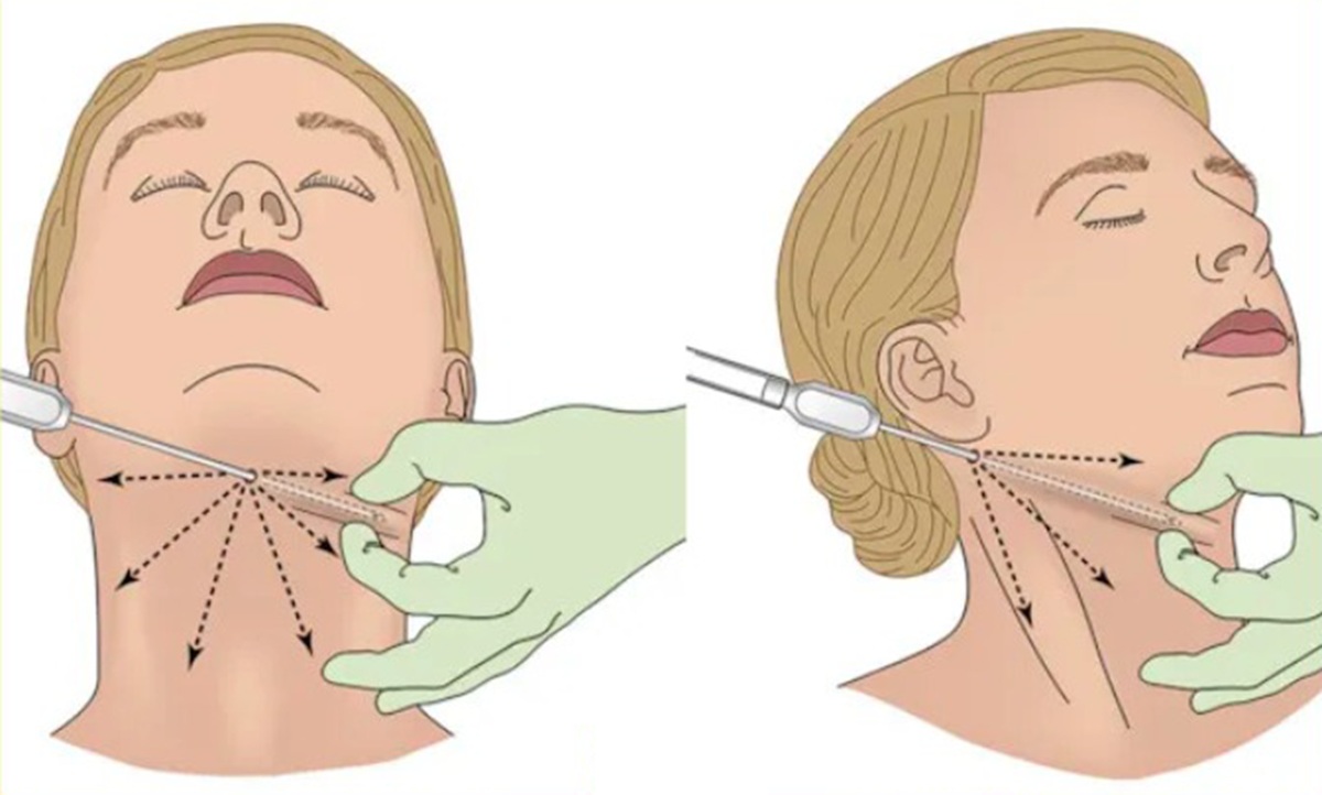 Quy trình hút mỡ nọng cằm