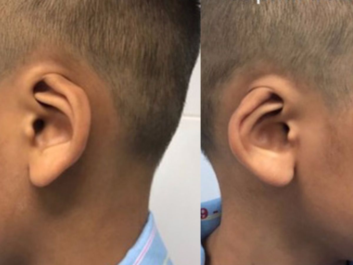 Hình ảnh vành tai trẻ sơ sinh bị cụp - Dấu hiệu nhận biết dị tật tai