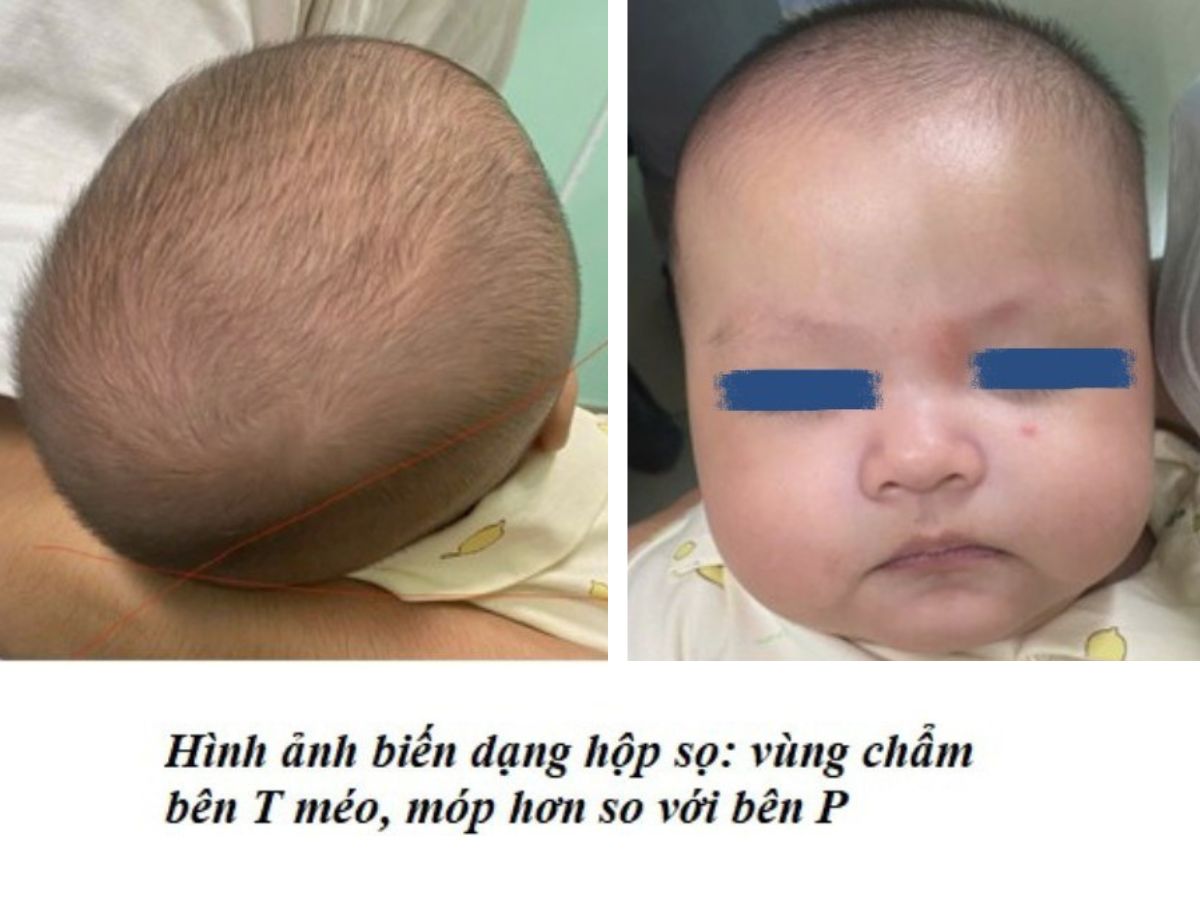 Hình ảnh biểu hiện của biến dạng hộp sọ khi bé bị hẹp sọ
