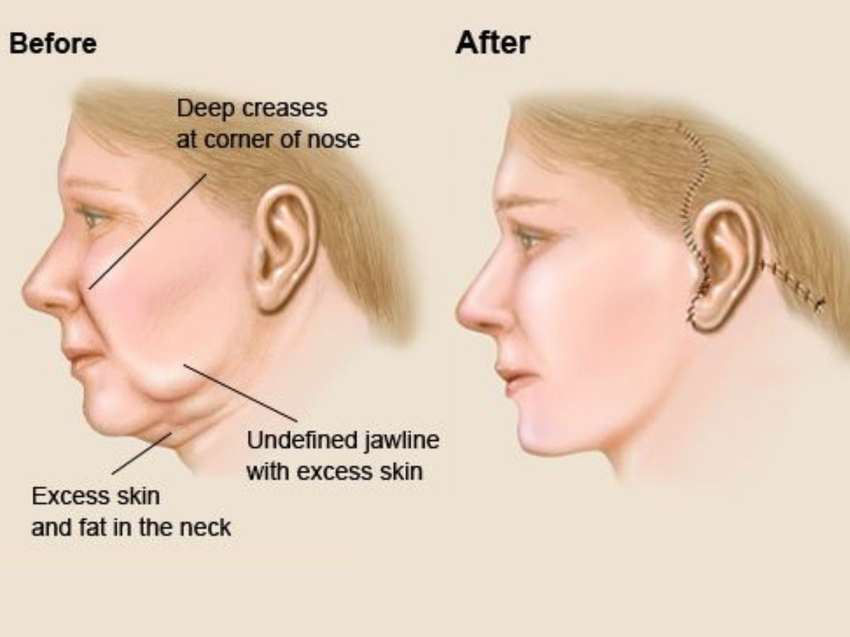 Một số phương pháp phẫu thuật da mặt phổ biến