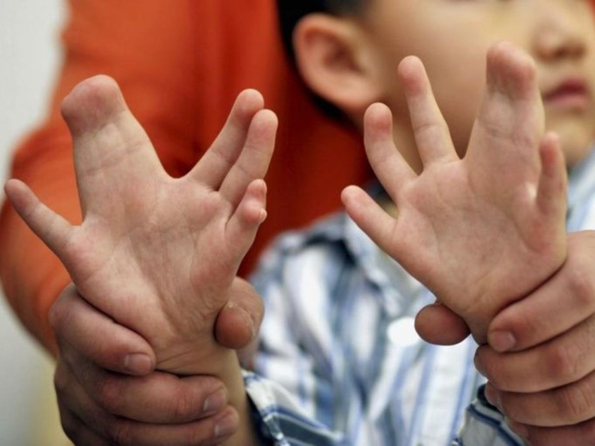 HÌnh ảnh bàn tay bị thừa ngón