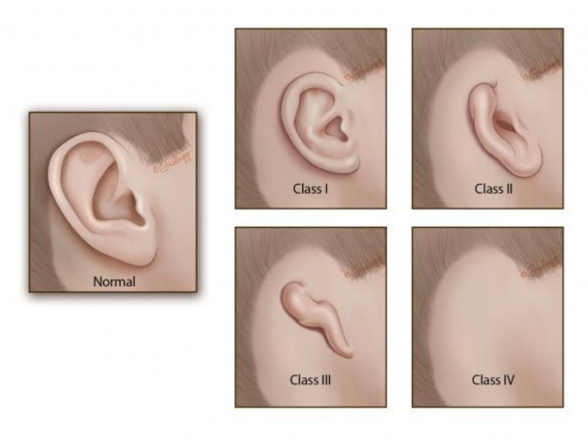Hình ảnh minh họa mức độ dị tật tai nhỏ ở trẻ
