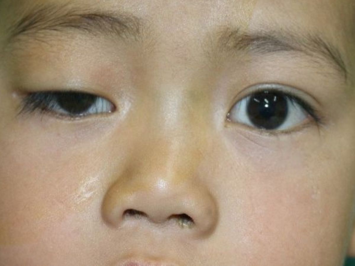 Sụp mí mắt bẩm sinh