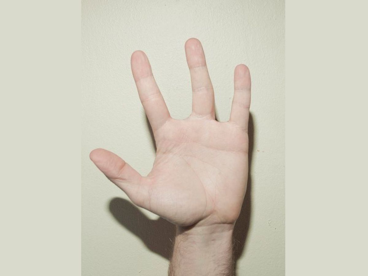 Hình ảnh bàn tay bị thiếu ngón