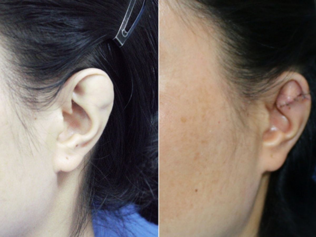 Hình ảnh trước - sau khi phẫu thuật dị tật vành tai