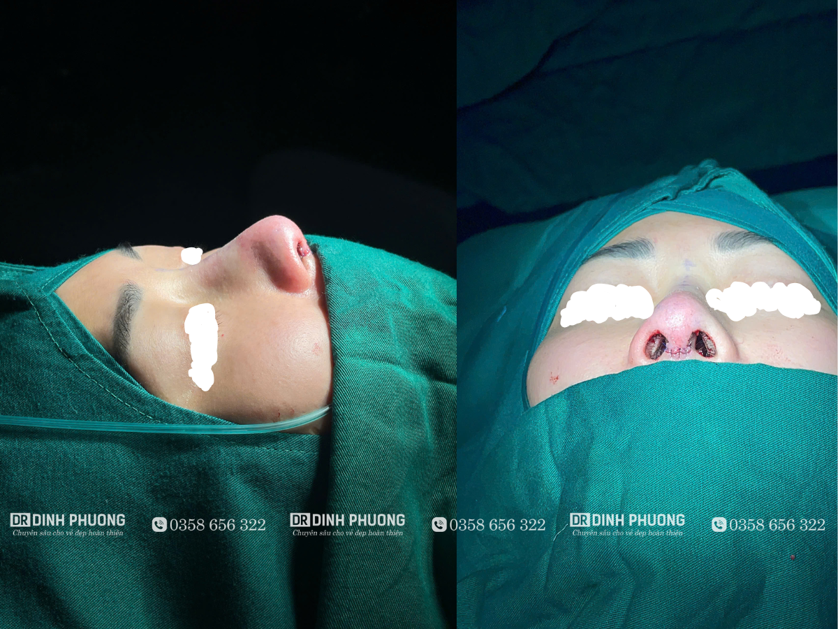 Hình ảnh sau khi phẫu thuật nâng mũi cấu trúc tại Dr. Trần Đình Phượng