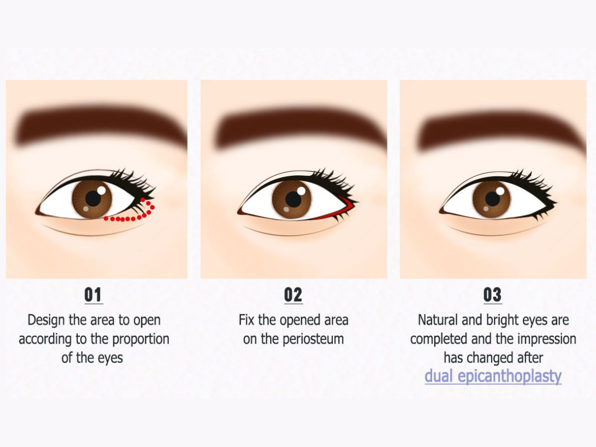 Mở rộng góc mắt giúp đôi mắt đẹp hơn 