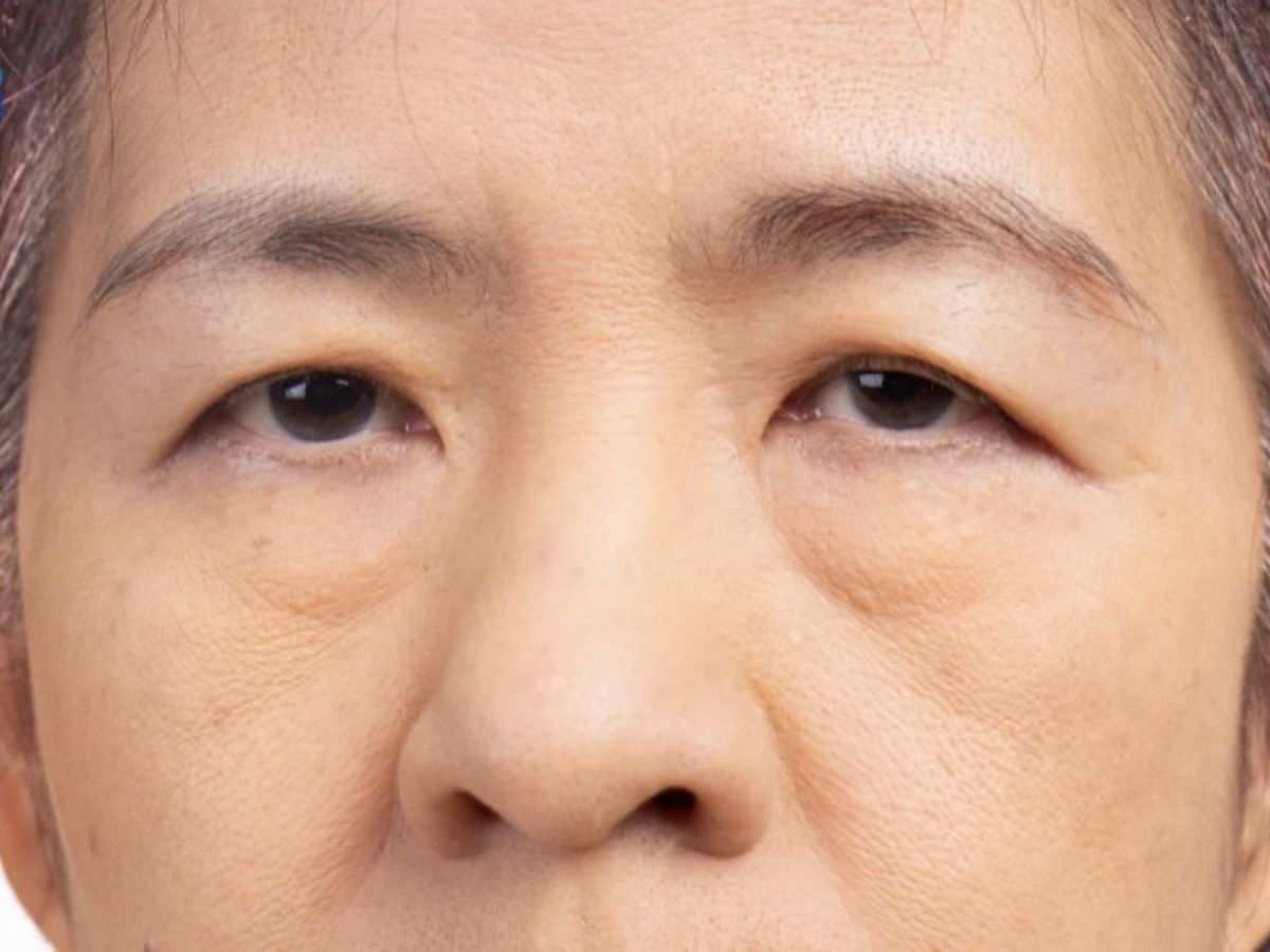 Sụp mí mắt do lão hóa