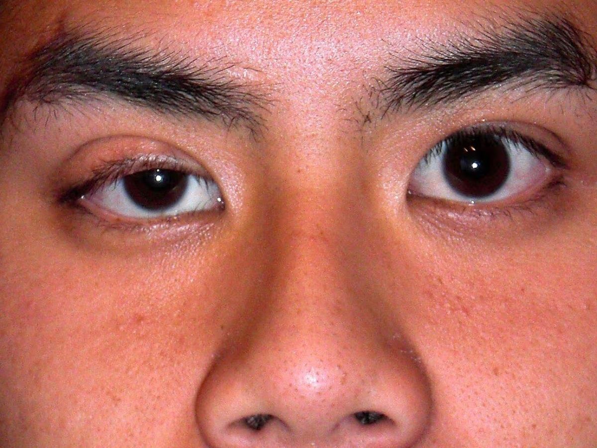 Sụp mí mắt do nhược cơ