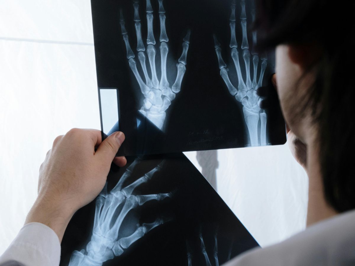 Chụp X quang là cách chẩn đoán phổ biến để xác định dị tật chi ngón tay