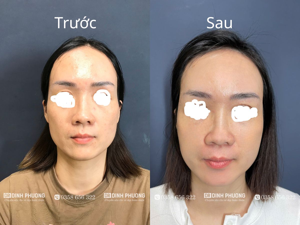 Hình ảnh trước và sau khi cấy mỡ mặt hai bên má tại bác sĩ Trần Đình Phượng.