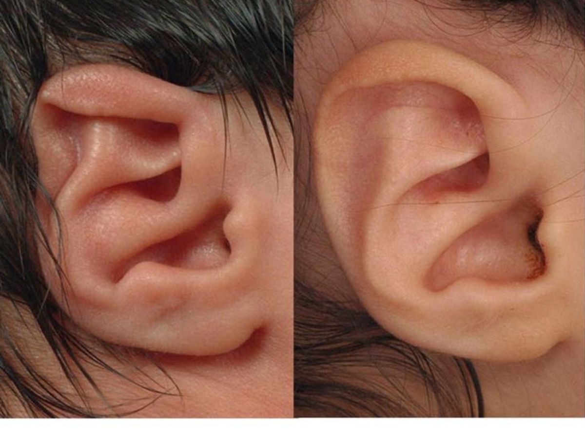 Nguyên nhân gây ra tình trạng dị tật tai ở trẻ thường thấy