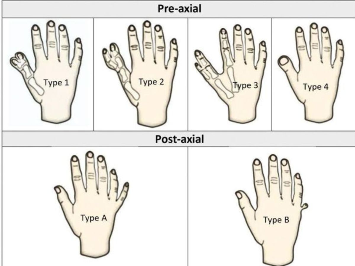 Các dạng dị tật tay thường thấy