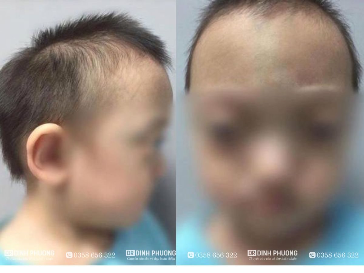 Hình ảnh chụp bên trái - phải khi bị hẹp sọ