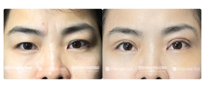 Kết quả một ca phẫu thuật mí đôi đẹp tự nhiên, an toàn tại bác sĩ Trần Đình Phượng