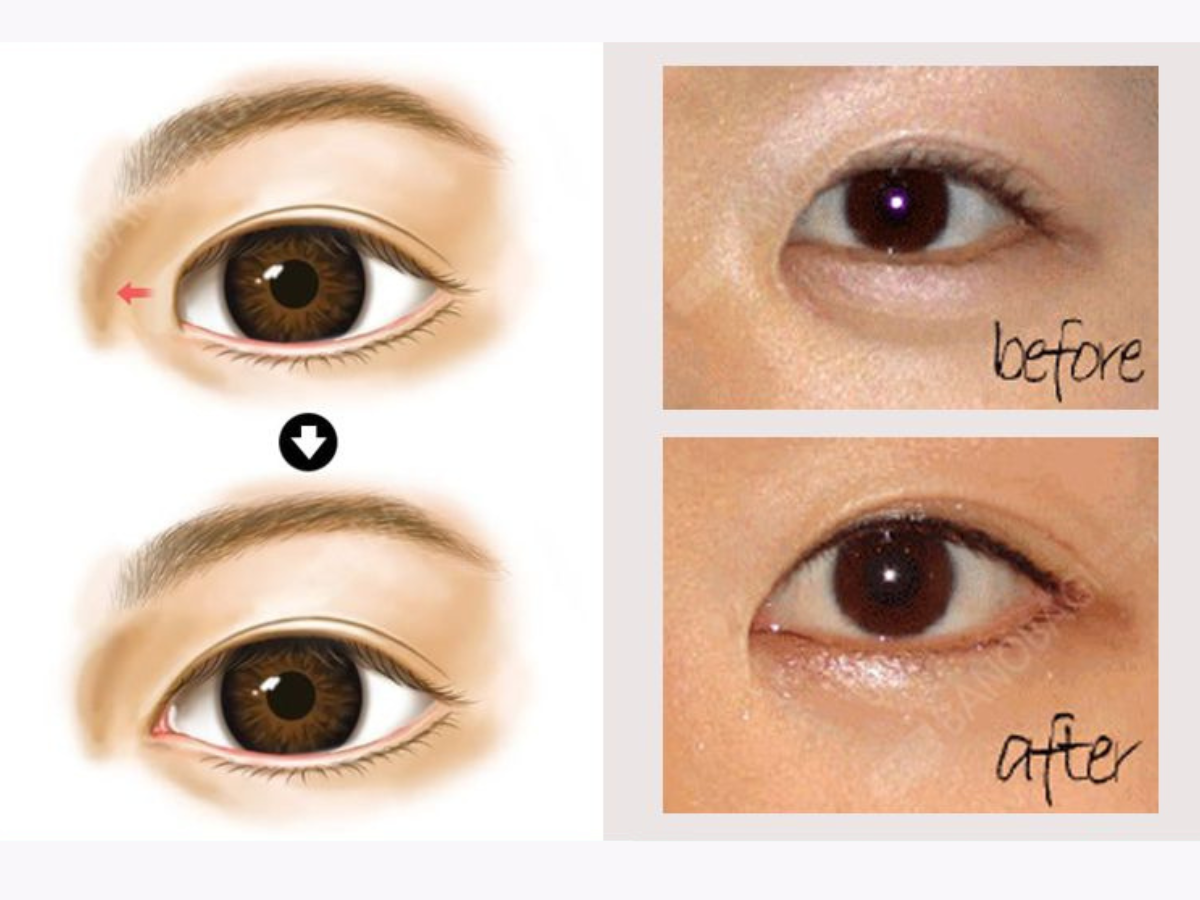 Hình ảnh trước và sau khi phẫu thuật mở rộng góc mắt