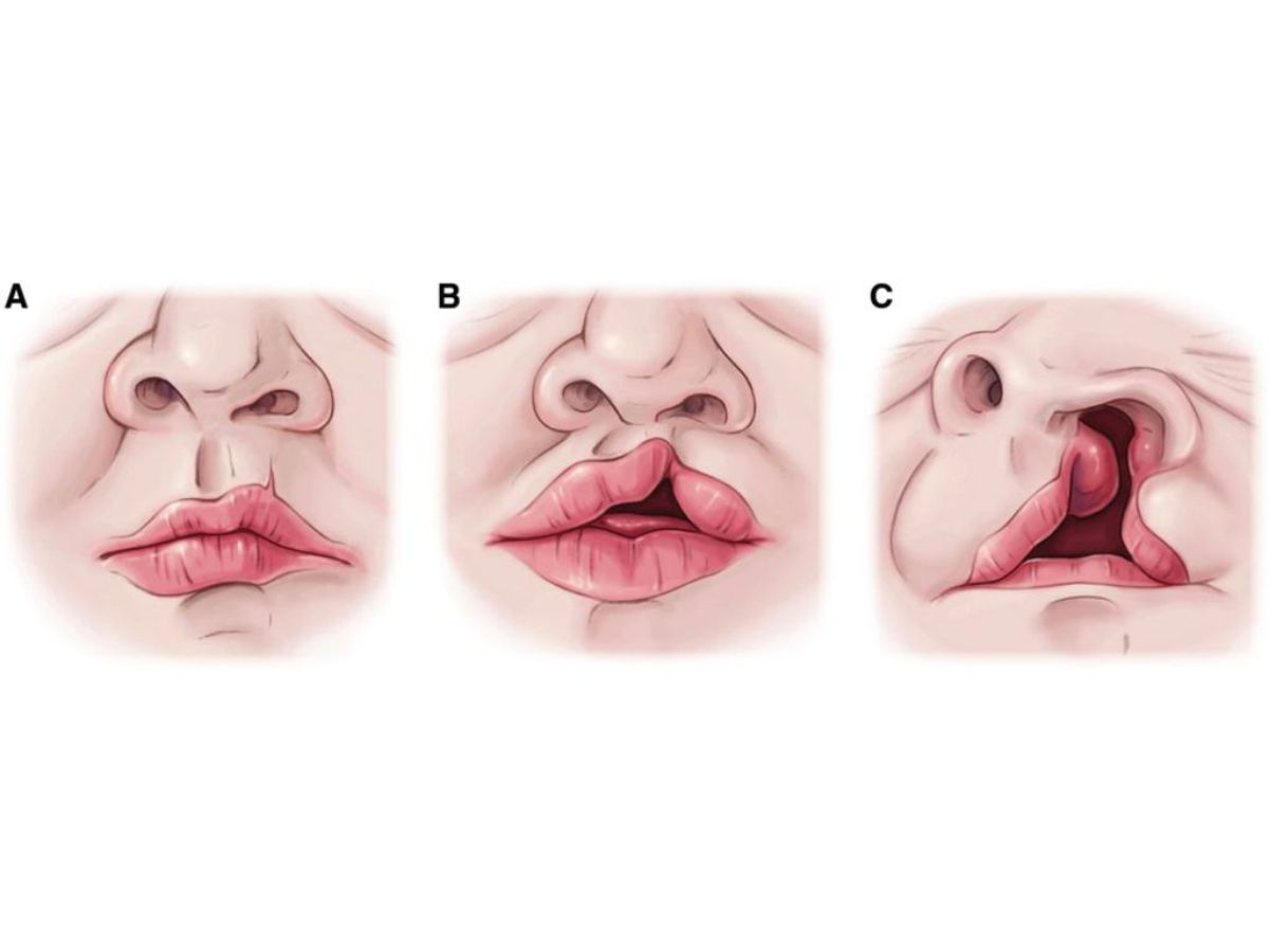 Điều trị phẫu thuật khe hở môi