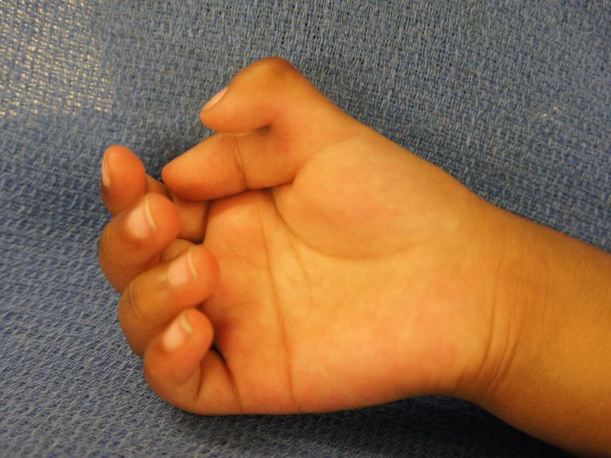 Dị tật tay ảnh hưởng trực tiếp đến chất lượng cuộc sống, sinh hoạt thường ngày