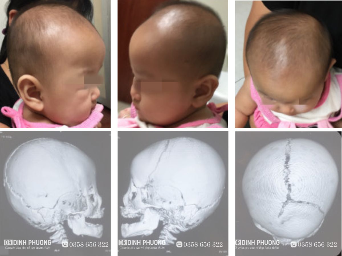 Hình ảnh chụp X-Quang và thực tế khi bé bị hẹp sọ bẩm sinh