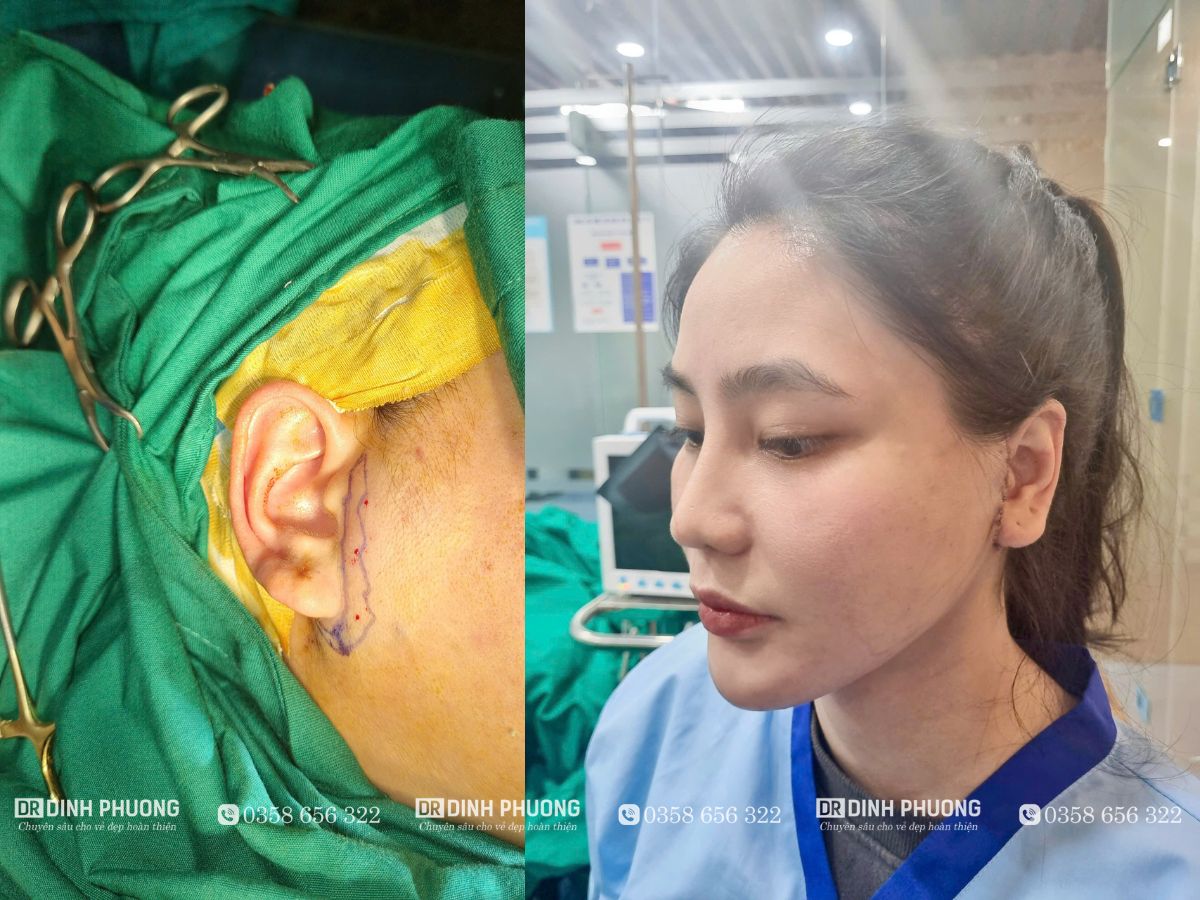 Khách hàng thực hiện căng da mặt mini tại Dr. Trần Đình Phượng