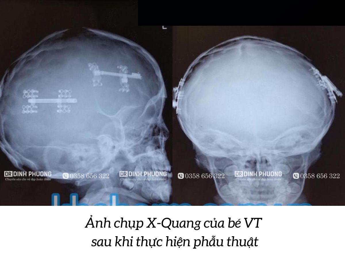 Hình ảnh chụp X-Quang sau khi được điều trị dính khớp sọ