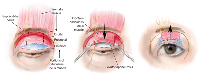 Kỹ thuật vạt cơ trán