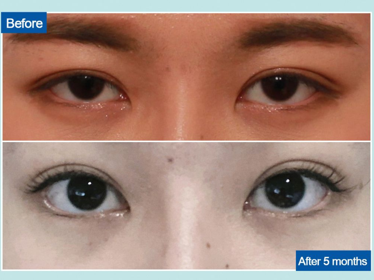  Hình minh họa trước và sau khi phẫu thuật mở rộng góc mắt 5 tháng (Sưu tầm)