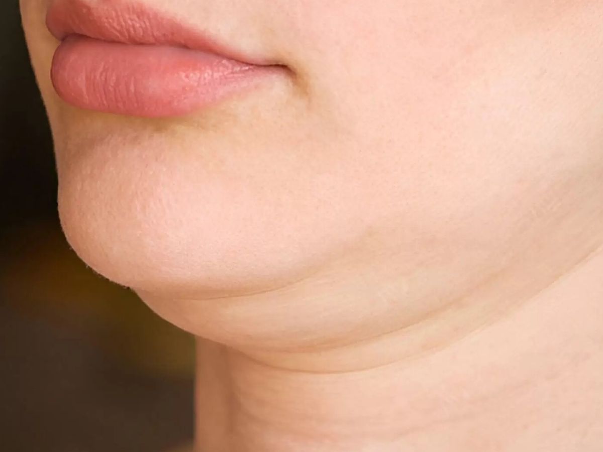 Người có mỡ thừa vùng cằm rõ rệt có thể thực hiện hút mỡ thu gọn nọng cằm